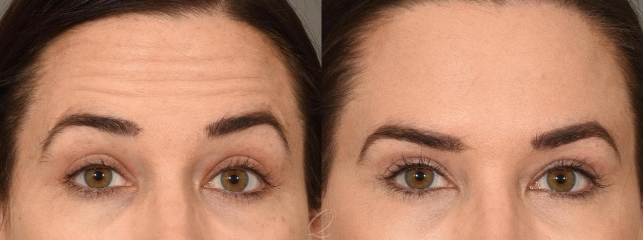 BOTOX® Case 1001296 Before & After View #1 | Rochester, NY | Quatela Center for Plastic Surgery
