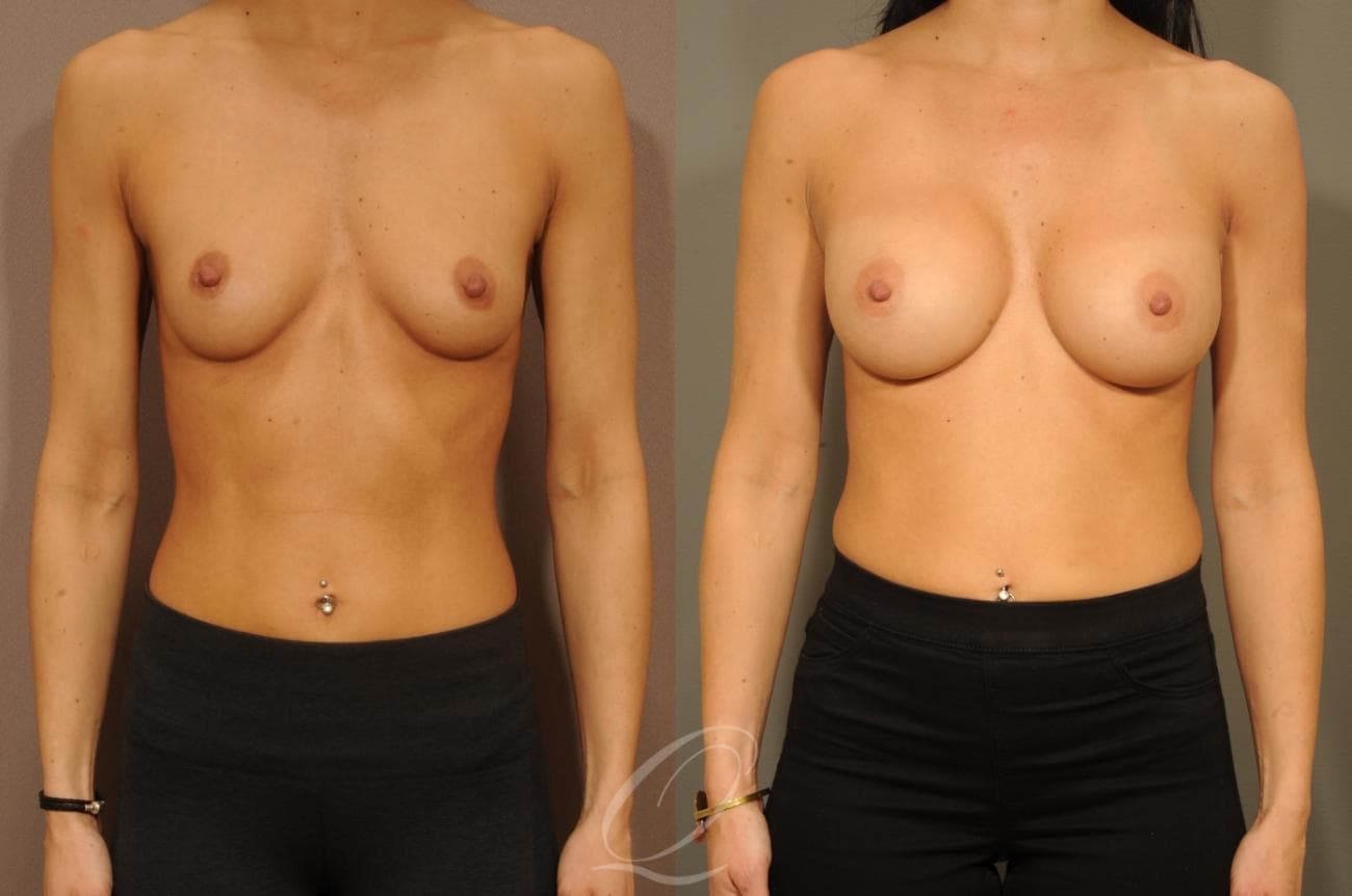 Breast Augmentation Case 1300 Before & After View #1 | Rochester, NY | Quatela Center for Plastic Surgery
