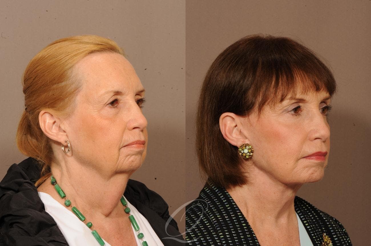 Facelift Case 1233 Before & After View #2 | Rochester, NY | Quatela Center for Plastic Surgery