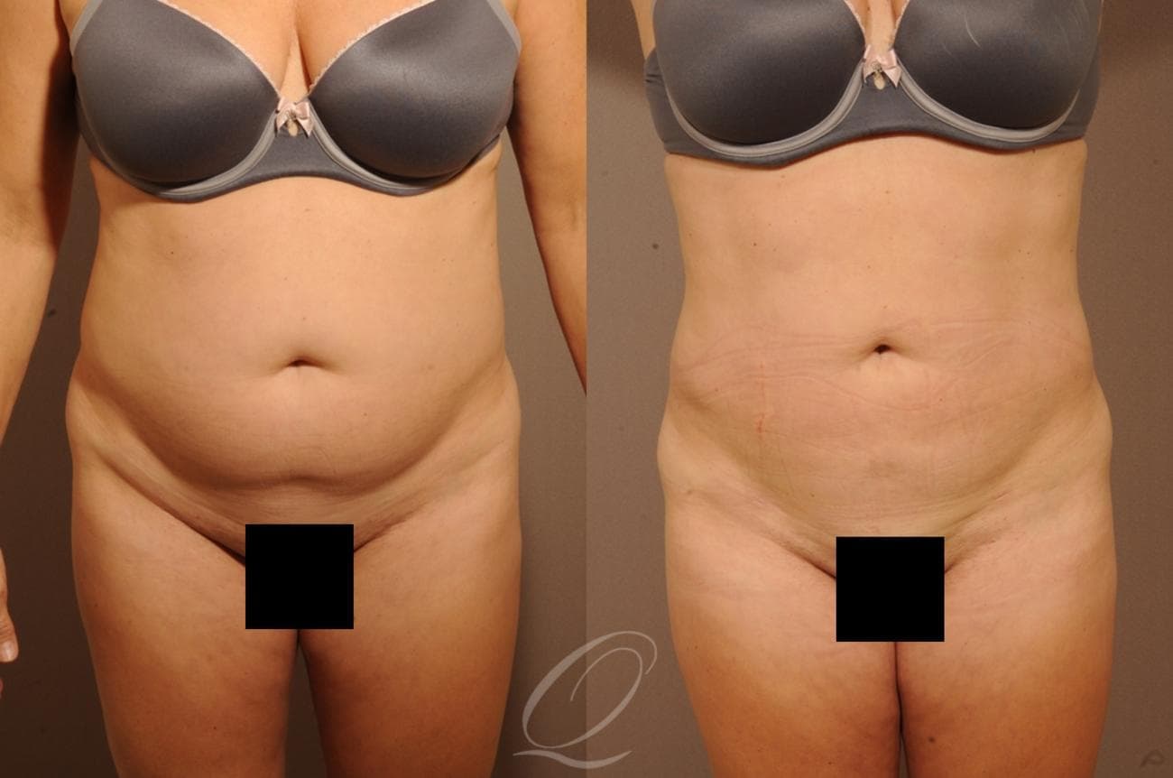 Liposuction Case 1257 Before & After View #1 | Rochester, NY | Quatela Center for Plastic Surgery