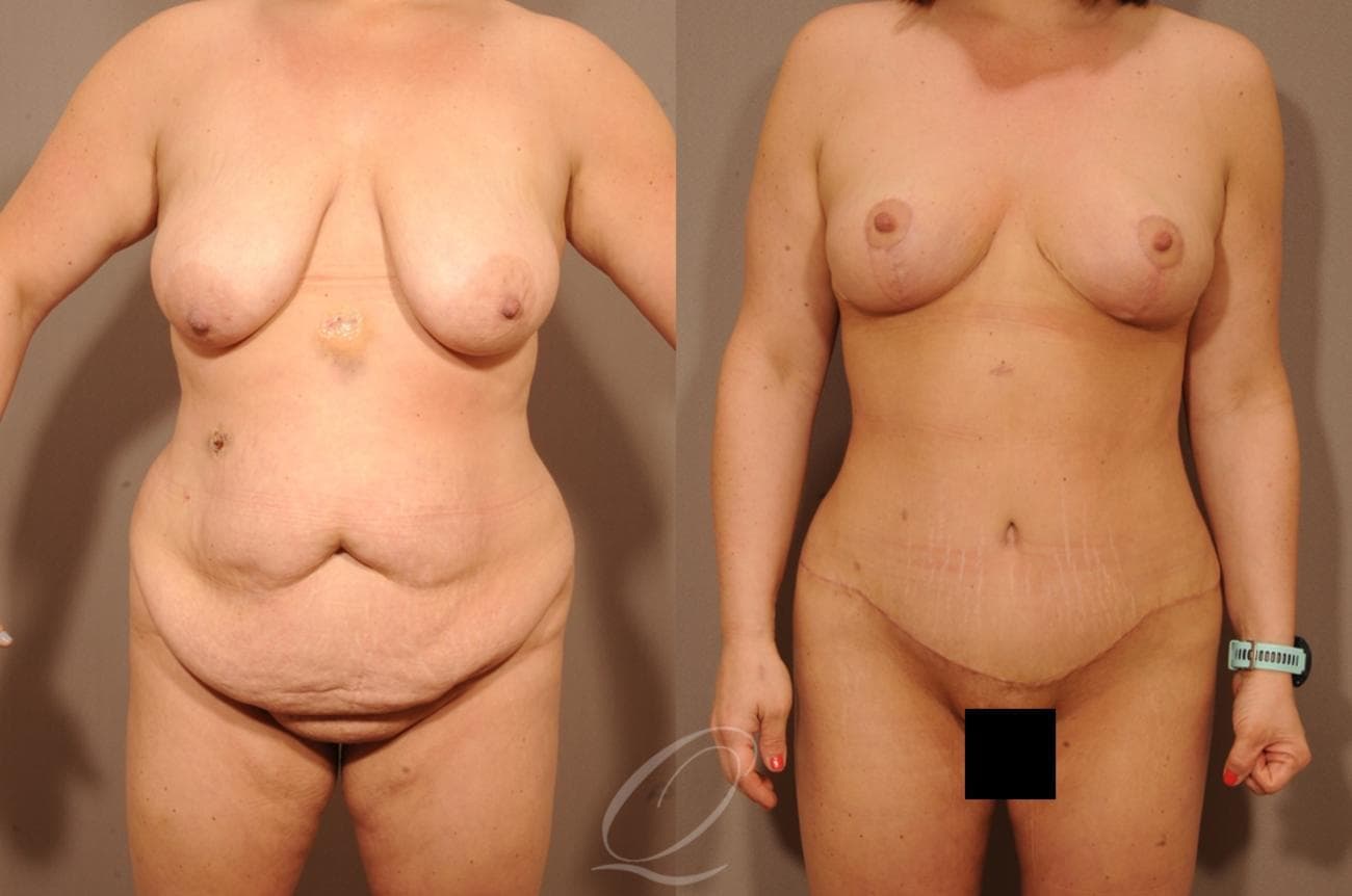 Mommy Makeover Case 1236 Before & After View #1 | Rochester, NY | Quatela Center for Plastic Surgery