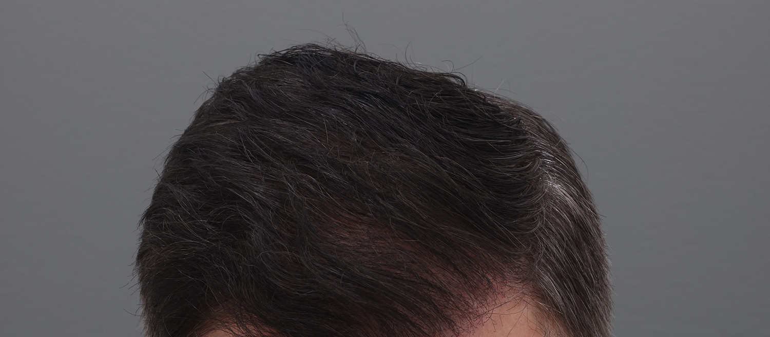 David after hair transplant