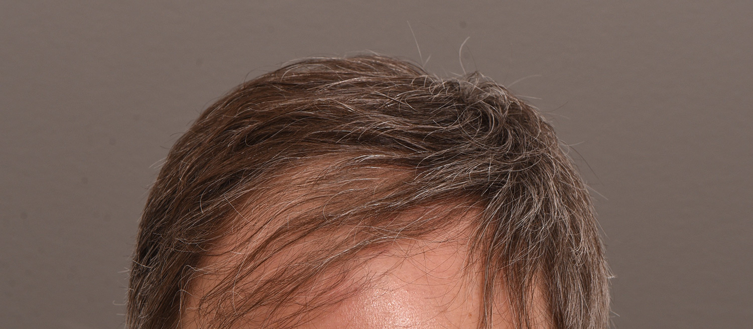 David before hair transplant