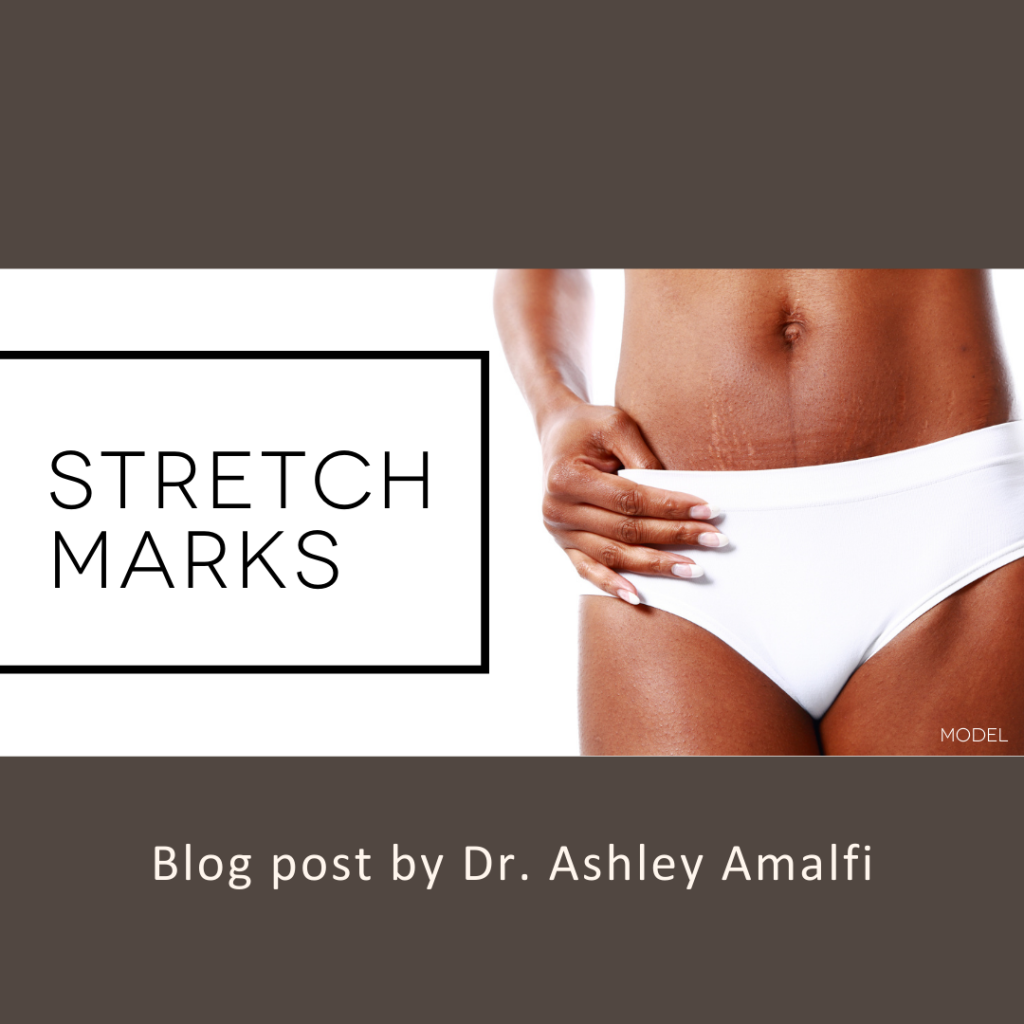 What Are Stretch Marks, and What Can I Do to Get Rid of Them