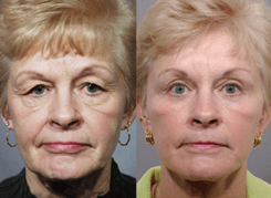Before and after of real patient