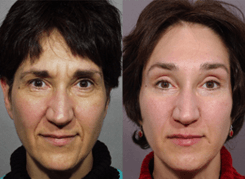 Before and after of real patient