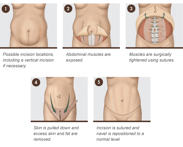 Tummy Tuck procedure diagram