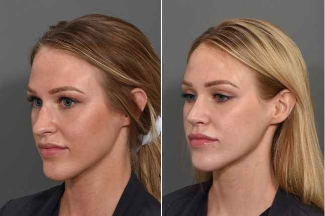 Rhinoplasty before and after