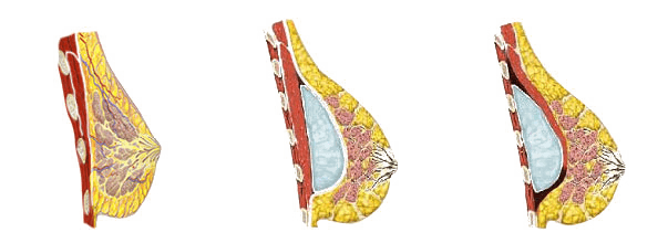diagram of different breast implants