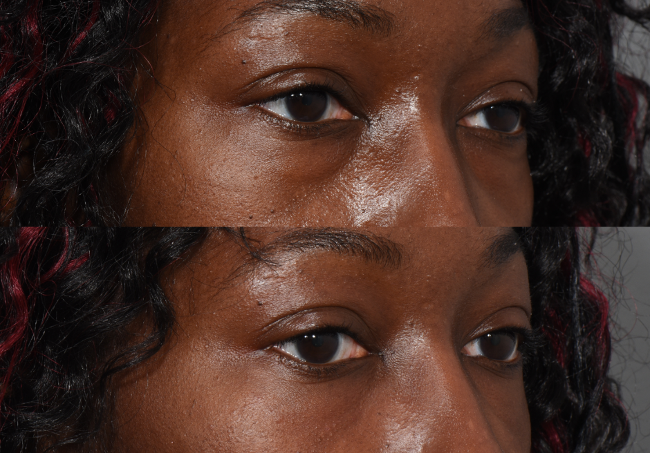 Under eye filler before and after