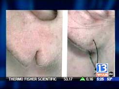 split earlobe repair, plastic surgery news, plastic surgery information rochester new york, ny plastic surgeons