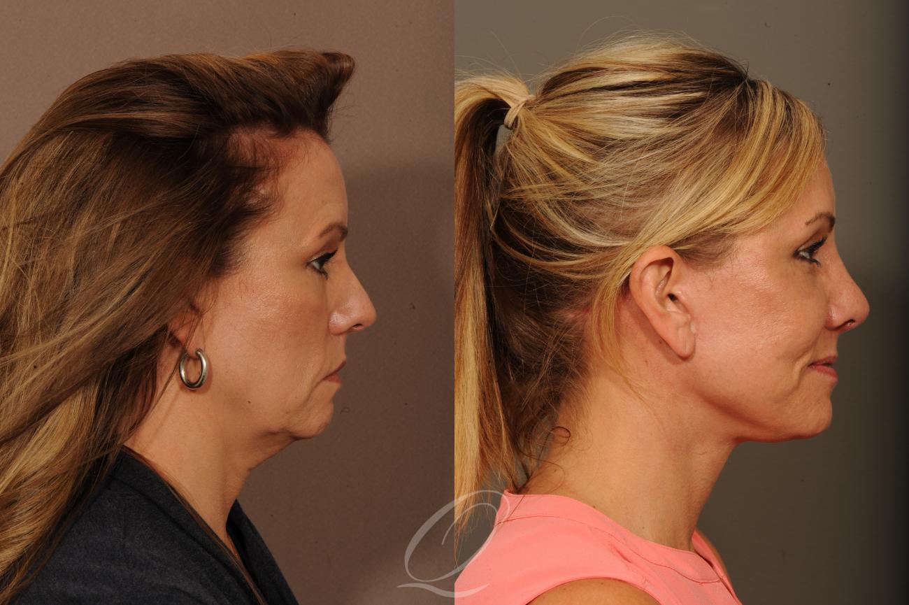 Woman's profile before and after facial plastic surgery