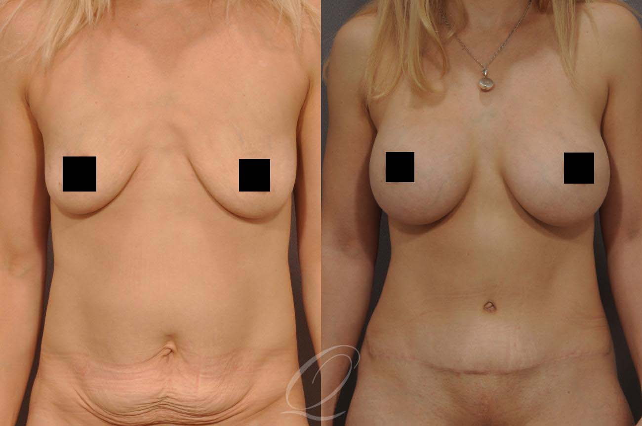 Woman's torso before and after mommy makeover surgery