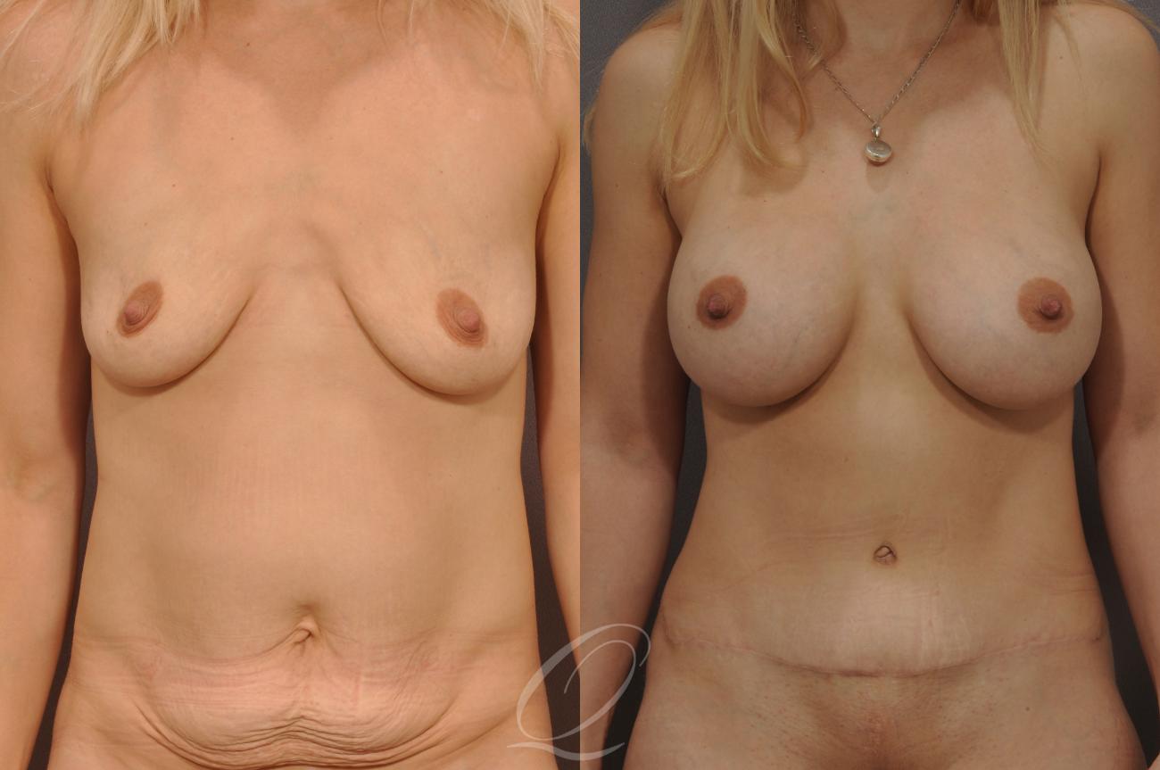 Woman's torso before and after mommy makeover surgery