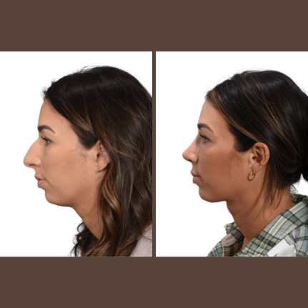 Before and After side view of deep neck contouring