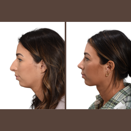 Get A Chiseled Jawline Without Surgery