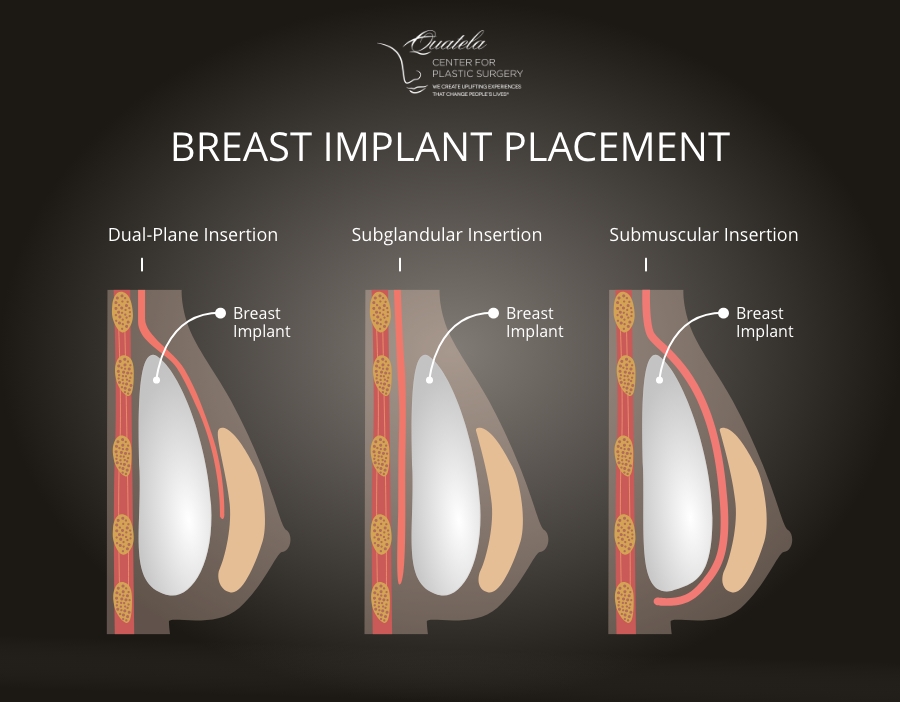 Breast implant placement graphic