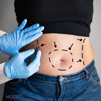 abdomen with markings for liposuction