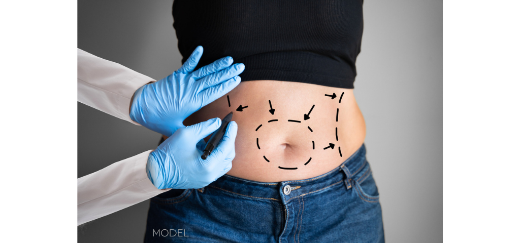 abdomen with markings for liposuction