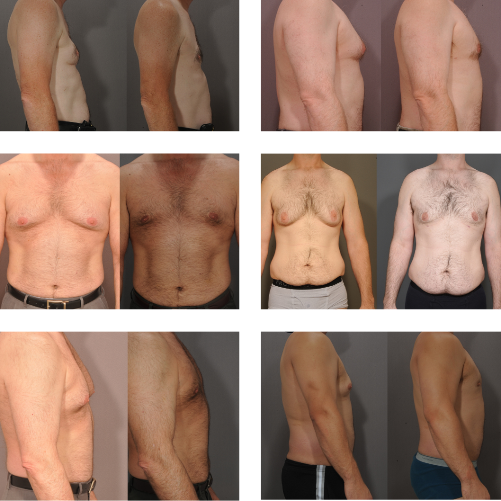 male breast reduction before and afters