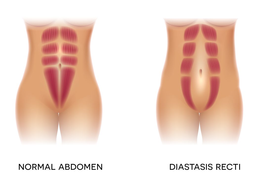 Diastasis Recti