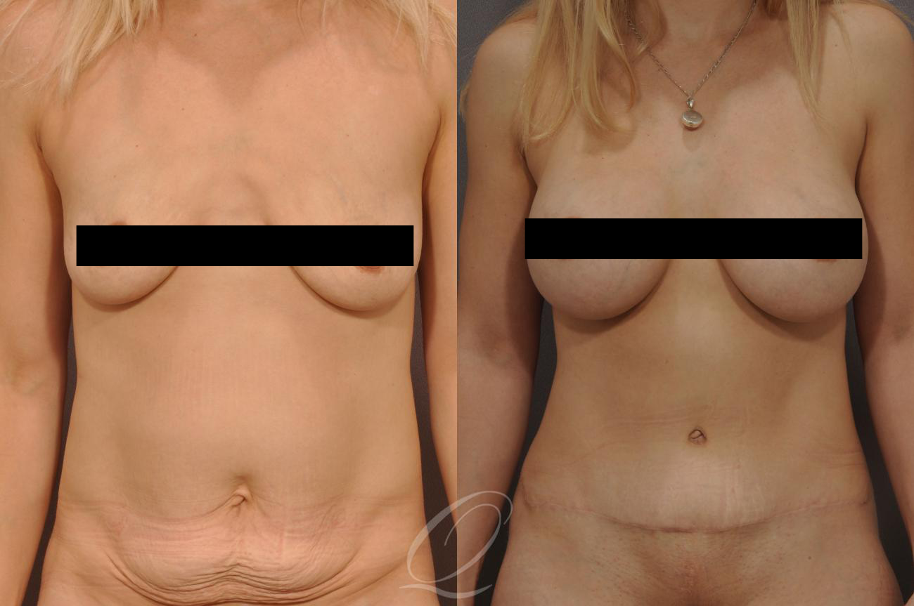 before and after breast augmentation