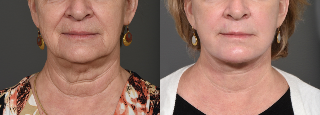 Perioral (around the mouth) dermabrasion before and after photo