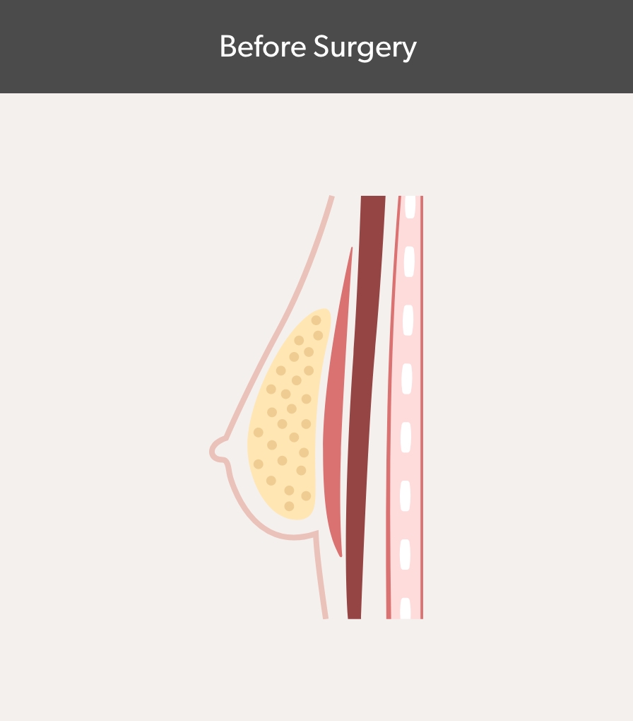 Before Surgery