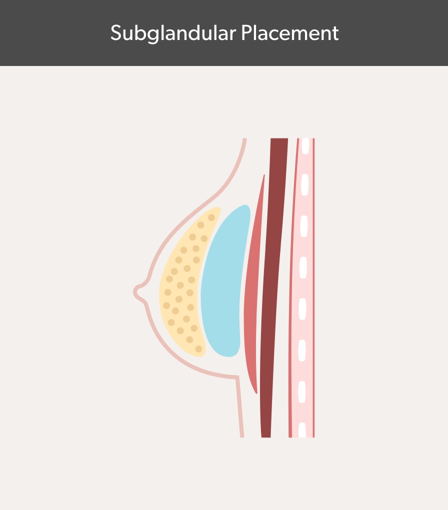 Subglandular Placement