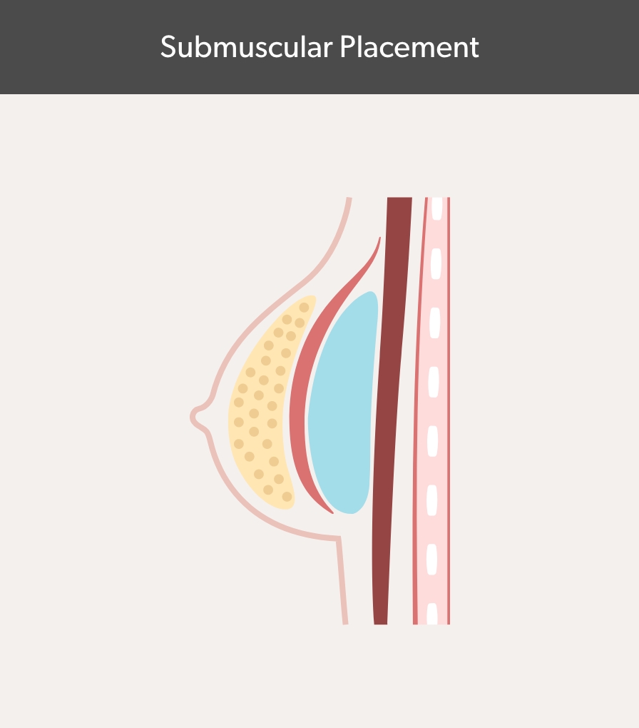 Submuscular Placement