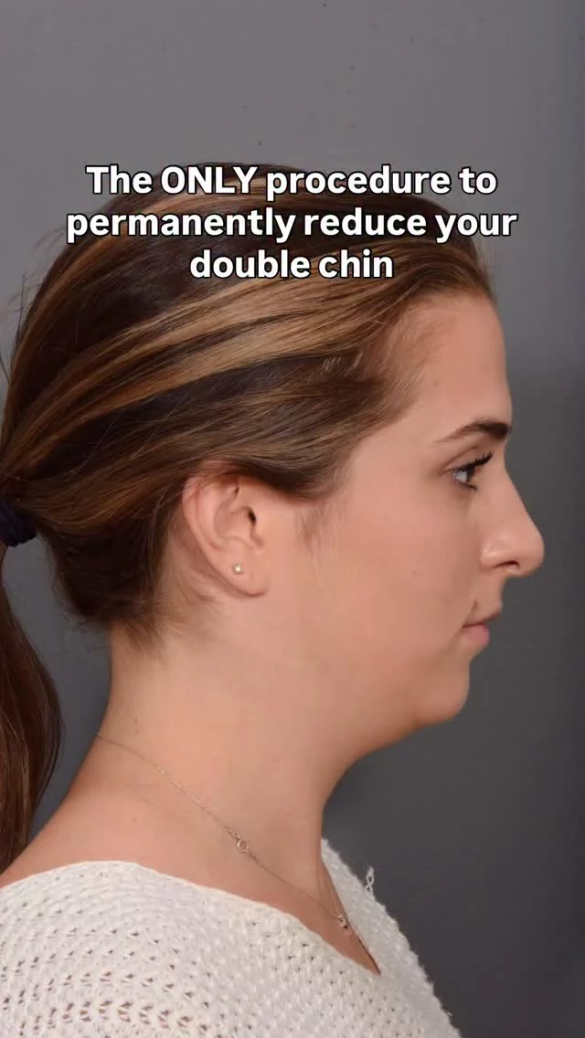 For definition that lasts and looks natural.
Deep neck contouring goes beyond surface-level fat removal. This surgical procedure reshapes the underlying structure of the neck by tightening muscles, removing deep fat, and refining bulky glands - creating a sculpted, lasting contour.
Performed by Dr. Vito Quatela, it’s ideal for patients seeking permanent improvement in the neck and jawline - especially when liposuction alone isn’t enough.
Surgeon: World-Renowned Double Board-Certified Facial Plastic Surgeon, Dr. Vito Quatela
Comment “DETAILS” to learn more about this procedure!