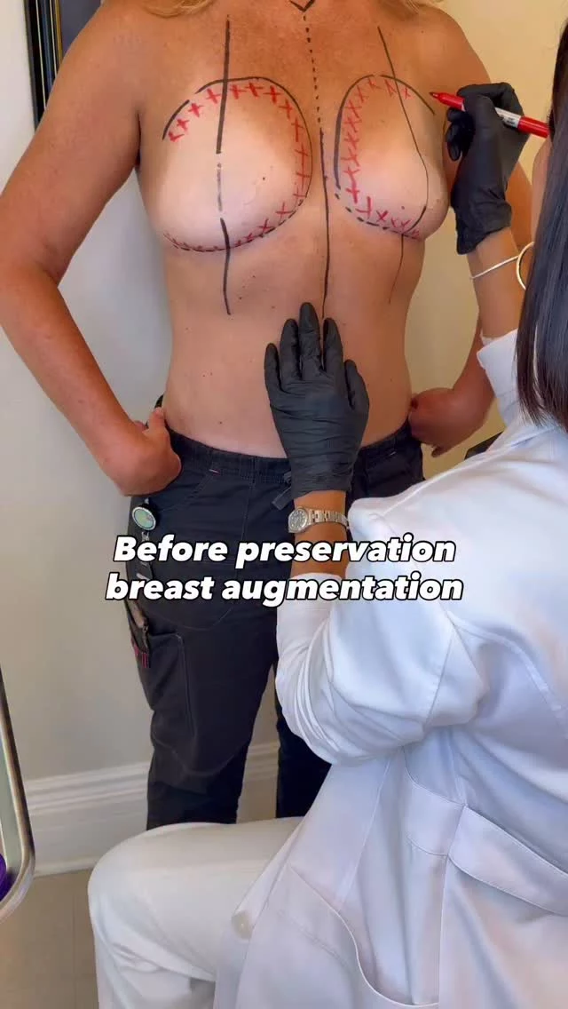Just 7 days post-op and the incisions are barely visible. They’re tiny and discreet, carefully hidden beneath the natural fold of the breast.

This is breast preservation - an advanced augmentation technique that avoids cutting through muscle or major tissue. Instead, a pocket is gently created for the implant, preserving your body’s natural structure.

Why patients choose it:
→ Sensation stays intact
→ Full muscle strength (yes, you can still work out)
→ Minimal, hidden scars
→ Smoother, faster recovery
→ Results that continue to soften and settle naturally over time

Perfect for first-time patients, active lifestyles, and anyone who wants natural-looking results without compromising function.
@drashleyamalfi is specially trained in this technique - delivering results that feel as good as they look.

Comment or DM us “PRESERVATION” to learn more.