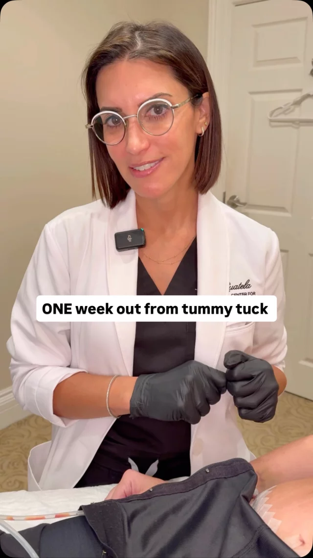 This incredible mama is just 7 days post-op from her tummy tuck, and look at these results already!

After three babies left her with significant muscle separation,  @drashleyamalfi performed an abdominoplasty to restore her core and create a beautifully contoured abdomen. Even with some swelling still present, you can already see her abdominal definition starting to show.

Back in April 2021, we performed 325cc high-profile implants and a nipple reduction, giving her the subtle, natural look she wanted for her petite frame.

Her incision is healing beautifully, her belly button looks amazing, and she’s feeling great. Stay tuned as we share more updates as she continues to heal.

Surgeon: @drashleyamalfi