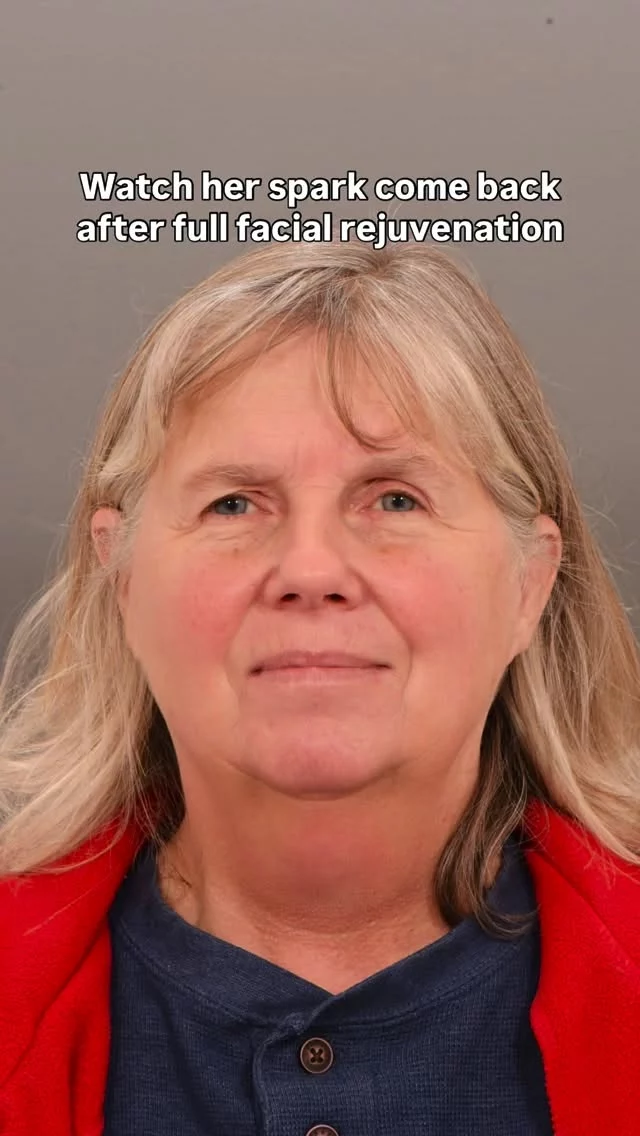 We still can’t get over this transformation

Seriously - just look at her! The way she lit up during this photoshoot was absolutely unforgettable.

Dr. Quatela’s work speaks for itself, but seeing her confidence shine through like this? That’s everything.

Surgery: Deep plane facelift, forehead lift, upper eyelid lift
Surgeon: World Renowned Double Board Certified Facial Plastic Surgeon Dr. Vito Quatela

Comment “DETAILS” for more info!