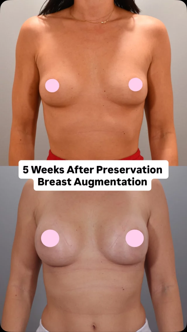 Here’s our lovely patient 5 weeks after her preservation breast augmentation — the awake procedure where the implant is gently nested for a soft, natural look.

She chose 265cc ergonomic demi implants to restore upper-pole fullness and enhance her cleavage. With only a tiny incision and no general anesthesia, recovery is quick and most patients are back to normal activities in about a day.

Surgeon: @drashleyamalfi 

Interested? With quick healing and minimal downtime, you’ll be February-break ready in no time. Comment “preservation” to learn more.