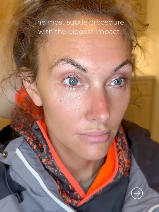 Tired of hearing “you look tired”?

Eyelid surgery (blepharoplasty) removes excess skin and fat from upper and lower eyelids, rejuvenating your entire appearance. Whether you’re dealing with sagging skin, under-eye bags, or heavy lids that obstruct your vision, our double board-certified facial plastic surgeons create natural results that restore your youthful look.

Comment or DM “EYES” to get started.