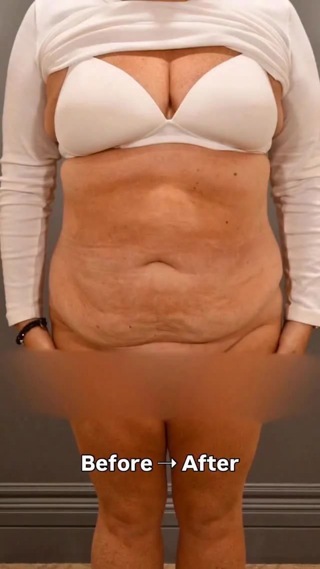 POV: you trusted the process and booked the vacation 🏖️

Extended tummy tuck + lipo + Renuvion

Surgeon: Dr. Ashley Amalfi

Comment “MAKEOVER” for more information about this procedure.