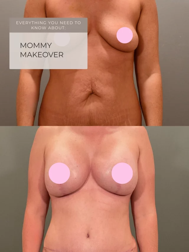 Having children doesn’t mean sacrificing your body confidence.

A Mommy Makeover combines breast and body procedures into one surgery with a single recovery period. Address multiple areas at once - whether it’s restoring volume, lifting what’s sagging, or removing stubborn fat that won’t budge.

Despite the name, it’s for any woman wanting to rejuvenate her body, not just mothers. Our board-certified plastic surgeons specialize exclusively in breast and body procedures, creating customized plans that safely deliver the results you want.

Comment or DM “MAKEOVER” to get started.