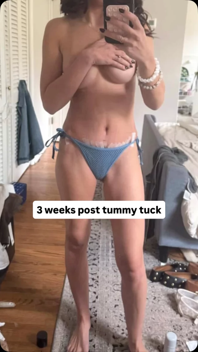 You don’t have to do everything at once to get the results you want! 

She started with a breast augmentation and now, just three weeks after her tummy tuck, her waistline is looking incredible. Her body is still healing, so it’s only going to get even better!

Surgeon: @drashleyamalfi 
Surgeries: Breast augmentation, nipple reduction, tummy tuck 
Implants: 325cc high-profile