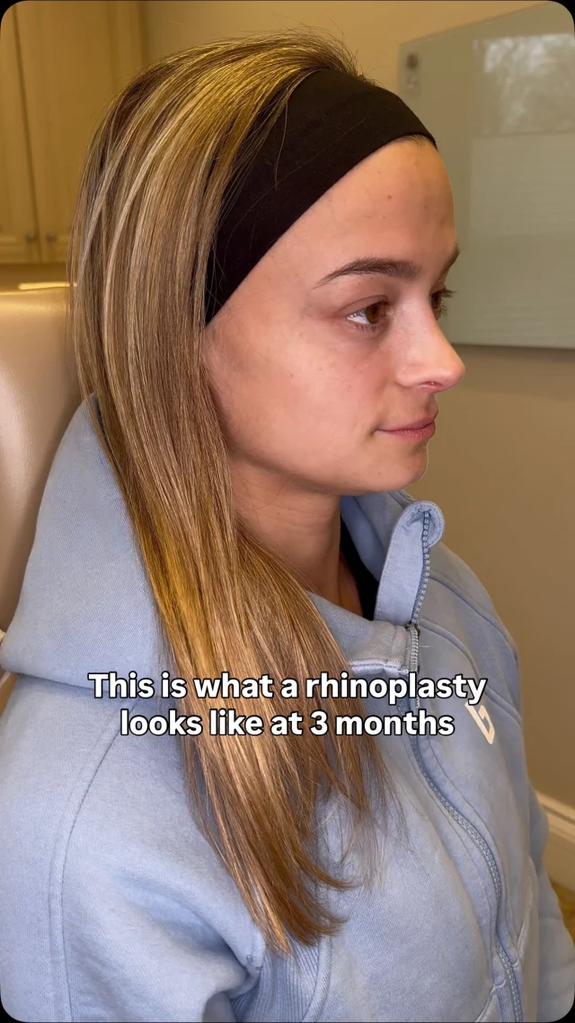 This lovely patient is 3 months out from her cosmetic rhinoplasty with @dralexmontague.

Subtle refinements can make a powerful difference. A smoother tip, a more lifted profile, and beautiful balance already taking shape with even more refinement to come as healing continues 🤍

Curious about rhinoplasty or want to learn more? Comment “RHINO”