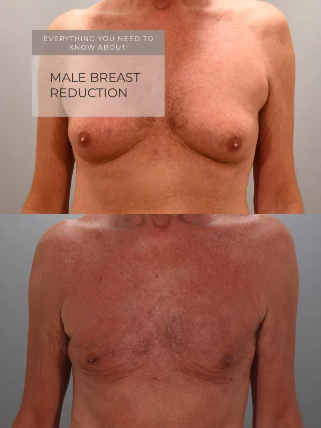 You’re not alone. Half of all men deal with this at some point in their lives.

Gynecomastia—enlarged male breast tissue—can make you self-conscious at the gym, avoid going shirtless, or skip activities you love. Caused by weight changes, hormones, genetics, or medications, it’s incredibly common from teenagers to older men.

Male breast reduction surgery removes excess tissue and fat to create a flat, masculine chest. Most guys are back to work in 2-3 days and fully active in 3 weeks. What we hear most? “I wish I’d done this years ago.”

Surgeon: @drashleyamalfi 

Comment or DM “MALE” to get started.