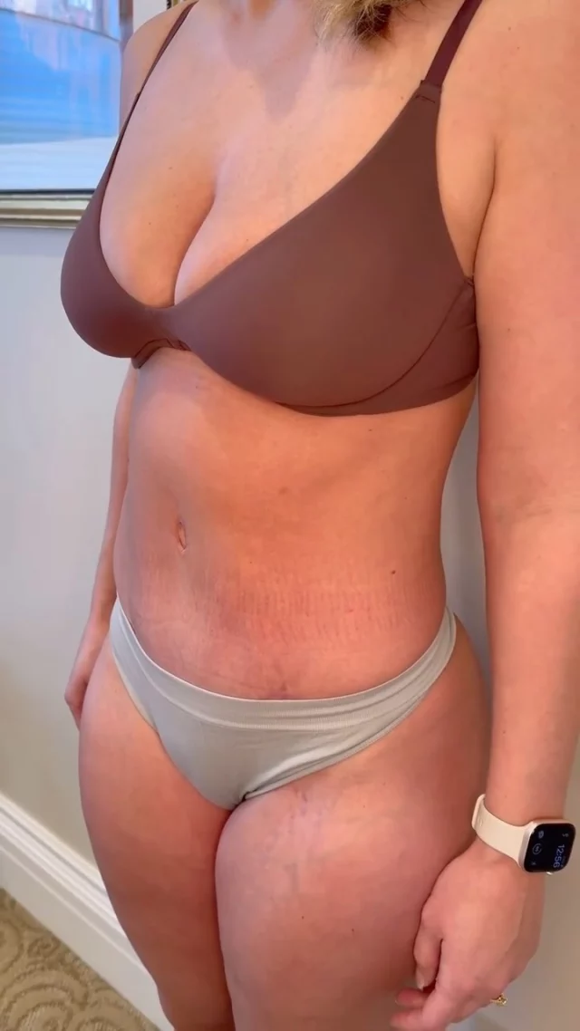 THIS is tummy tuck season! The kids are in their routine, you can bundle up comfortably during recovery, and you’ll be healed and confident by summer.

Starting now means you’re fully recovered and ready to enjoy warm weather without a second thought.

This is what’s possible just 3 months after a tummy tuck + targeted liposuction – a sculpted, natural result that gives you back the contours you want.

Performed by @drashleyamalfi, a board-certified plastic surgeon specializing in transformative body contouring.

Ready to take the next step? Comment or DM us “TUMMY”🤍