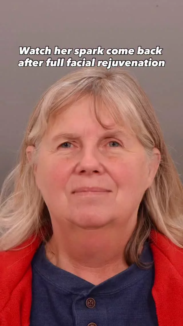 Wait until you see this transformation… 👀

The glow.
The confidence.
The moment she saw herself — unforgettable.

Procedures performed:
Deep Plane Facelift
Forehead Lift
Upper Eyelid Lift

Surgeon: World-renowned, double board-certified facial plastic surgeon Dr. Vito Quatela

DM “UPLIFT” for details🙌
