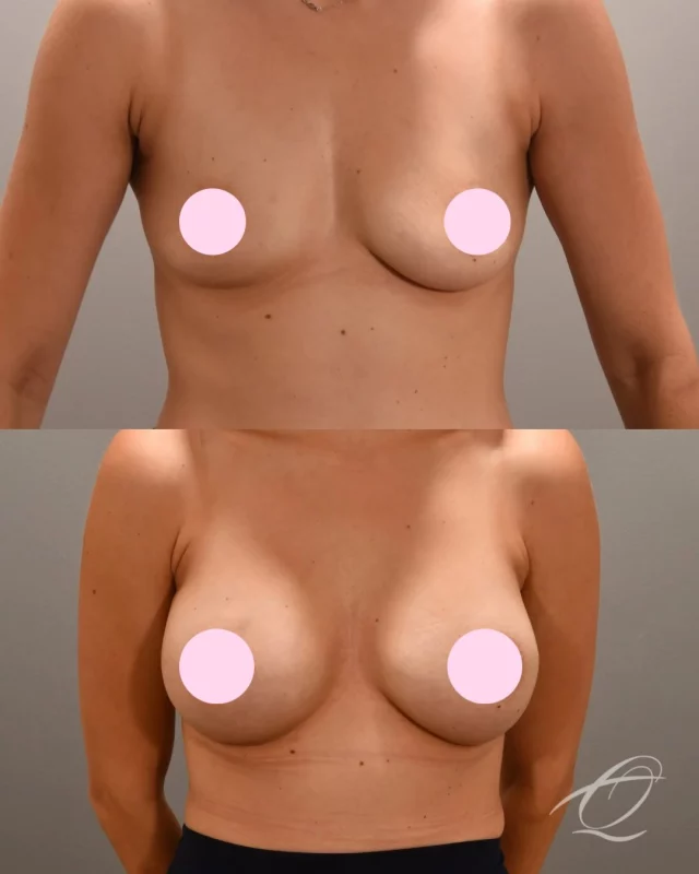Three pregnancies. Breastfeeding. Weight loss. Her breasts had been through a lot — and she was ready to feel like herself again.

She came to @drashleyamalfi as a small B cup. One year ago, Dr. Amalfi performed a submuscular breast augmentation using two different implant sizes — because her breasts weren’t perfectly symmetrical to begin with, and pretending otherwise wouldn’t have served her.

The result isn’t about achieving identical breasts. It’s about proportion. Balance. Results that look like they belong on her body. And at one year out? Those scars are barely there.

Implants: 375cc & 325cc
Post-Op: 1 year 

If breast augmentation has been on your mind, this is your sign to start the conversation. Comment AUG and we’ll send you a DM to book a consultation with one of our surgeons.
