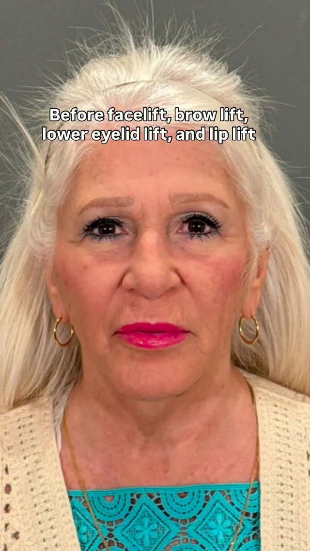 Six months post-op and looking incredible! 

This beautiful patient is halfway through her healing journey after a deep plane facelift, endoscopic brow lift, blepharoplasty, and lip lift with @dralexmontague. 

Her jawline is beautifully sculpted, eyes are bright and refreshed, lips are perfectly balanced — and the best part? She still looks completely like herself, just renewed.

The art of facial rejuvenation is all about enhancing your natural beauty while keeping what makes you uniquely you.

Interested in this procedure? Comment UPLIFT and we’ll DM you more information.