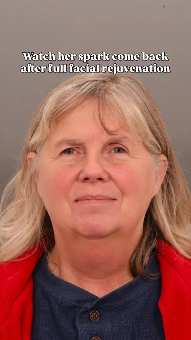 We still can’t get over this transformation

Seriously - just look at her! The way she lit up during this photoshoot was absolutely unforgettable.

Dr. Quatela’s work speaks for itself, but seeing her confidence shine through like this? That’s everything.

Surgery: Deep plane facelift, forehead lift, upper eyelid lift Surgeon: World Renowned Double Board Certified Facial Plastic Surgeon Dr. Vito Quatela

Send us a dm with the word “UPLIFT” for more info!