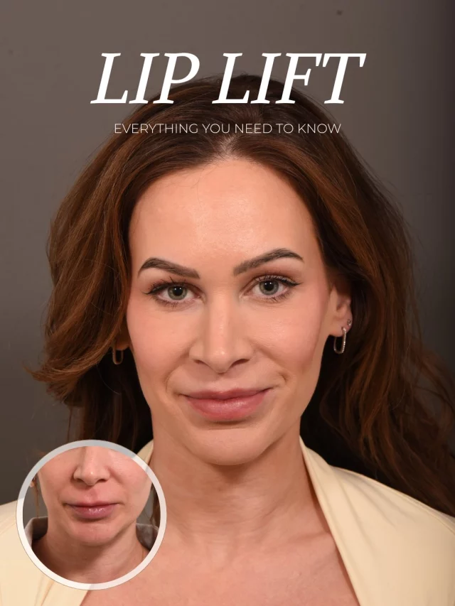 Does your upper lip seem to disappear when you smile? Or do you wish it looked fuller — without adding more filler?

A surgical lip lift enhances the upper lip by shortening the philtrum, increasing pink lip show, and reversing the downward roll that happens with age. The incision is placed at the base of the nose and designed to heal discreetly.

Want to learn more about lip lift surgery? Comment LIPS and we’ll send you a link with more information and connect you with a patient consultant.