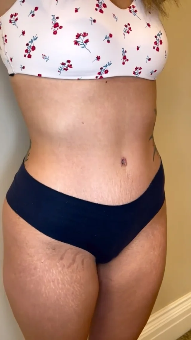 Three months after her tummy tuck and iliac liposuction with @drpeterkrasniak—and we’re honestly blown away.

Years ago, she had stomach surgery that left her with a scar she was never fully comfortable with. After having kids, she decided it was finally time to do something for herself—and the transformation speaks for itself. 

Her waistline, the definition, and that belly button… it looks completely natural, like it’s always been hers. The scar sits perfectly along the underwear line, making it virtually invisible, and it will continue to fade with time.

At just three months, she’s still in the early stages—swelling is going down and her shape is continuing to refine. Final results typically come into focus around the six-month mark, and she already looks incredible.

Comment “TUMMY” and we’ll send you everything you need to get started.